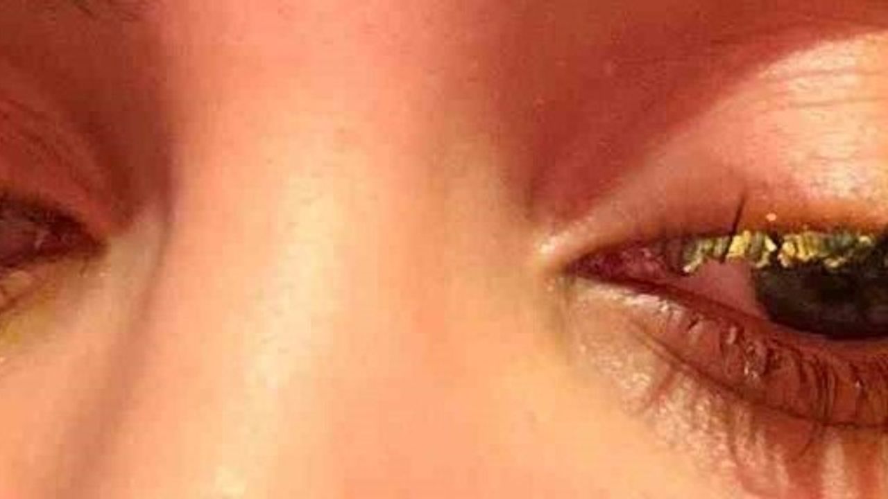 Esenyurt'ta kirpik yapıştırıcısı göze kaçtı, genç kadın kısmi körlük yaşadı