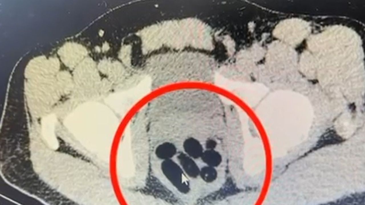 Kayseri'de Uyuşturucu Kuryesi Midesinde Ele Geçirildi