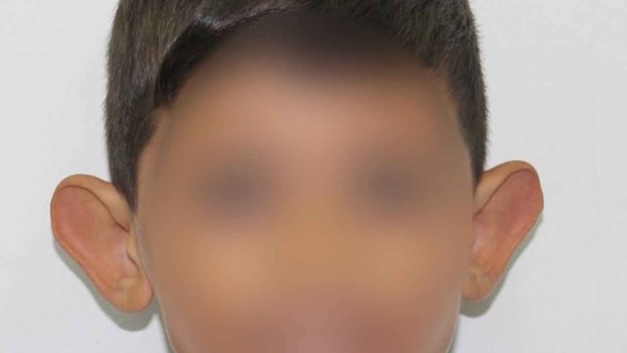 Kepçe kulak çocuklarda özgüveni zedeler: Erken müdahale önemli