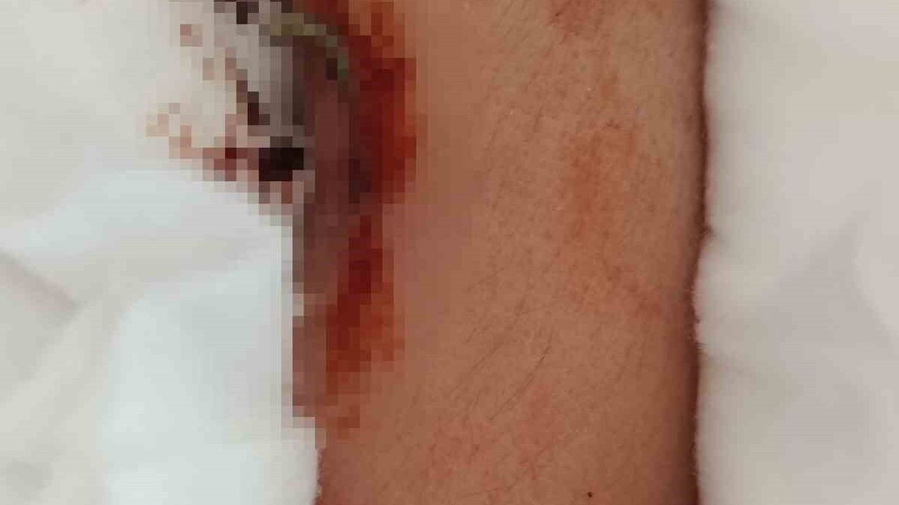 Büyükçekmece'de akran zorbalığı: 9 yaşındaki çocuğun arkadaşı kolunu iki yerinden kırıldı