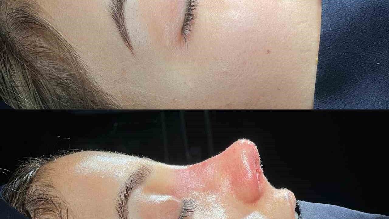 Cizre'de ilk revizyon rinoplasti başarıyla gerçekleştirildi