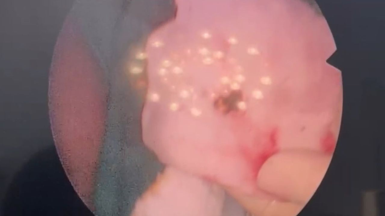 Elazığ'da estetik ameliyat sırasında burun taşı (rinolit) bulundu