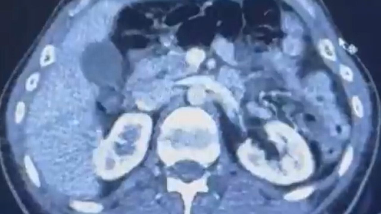 Kayseri'de mide kapsüllerinde 554 gram uyuşturucu ele geçirildi