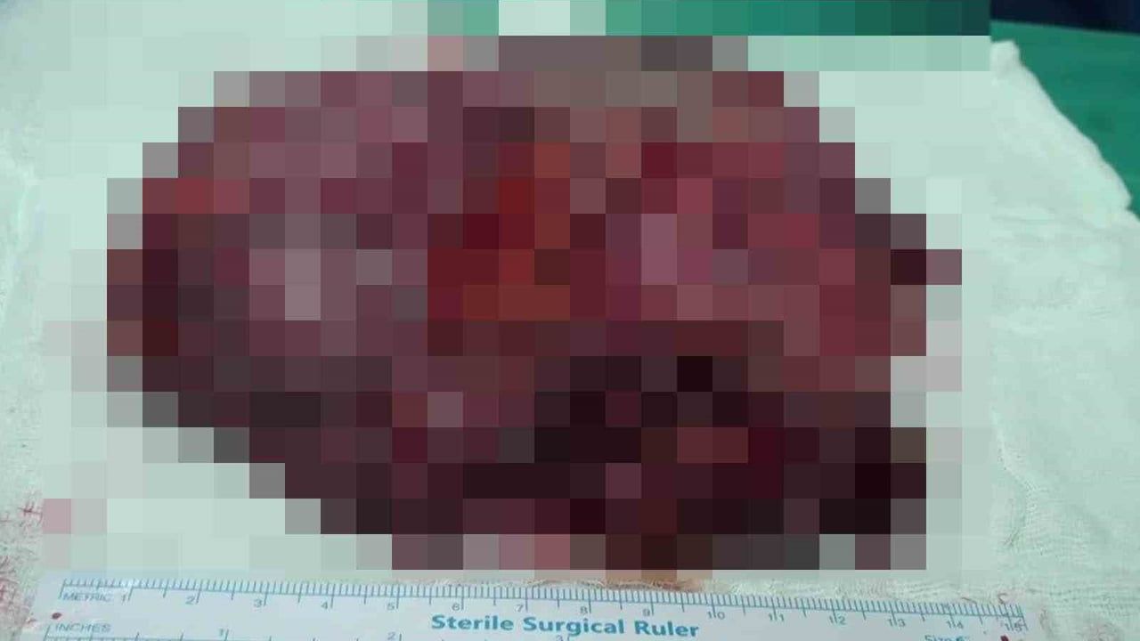 Şanlıurfa’da 25 santimetrelik dev kist ameliyatla çıkarıldı