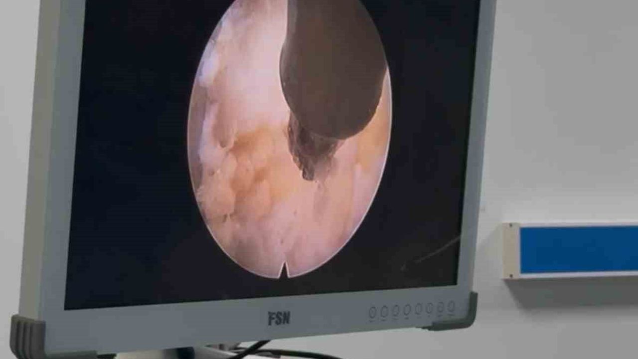 ADÜ Hastanesi'nde Tam Kapalı (Full Endoskopik) Lomber Disk Ameliyatları Başladı