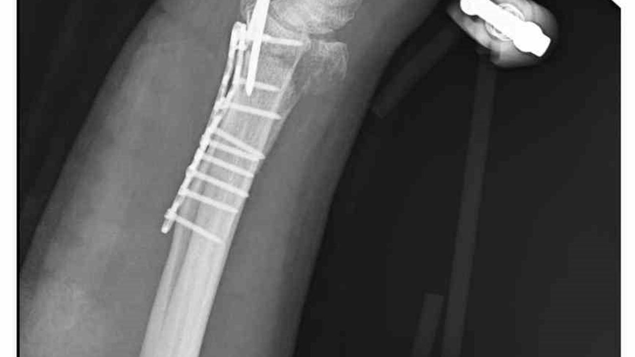 Ankara Mamak'ta sahipsiz köpeklerden kaçarken bileği kırılan kişi belediyeyi suçladı