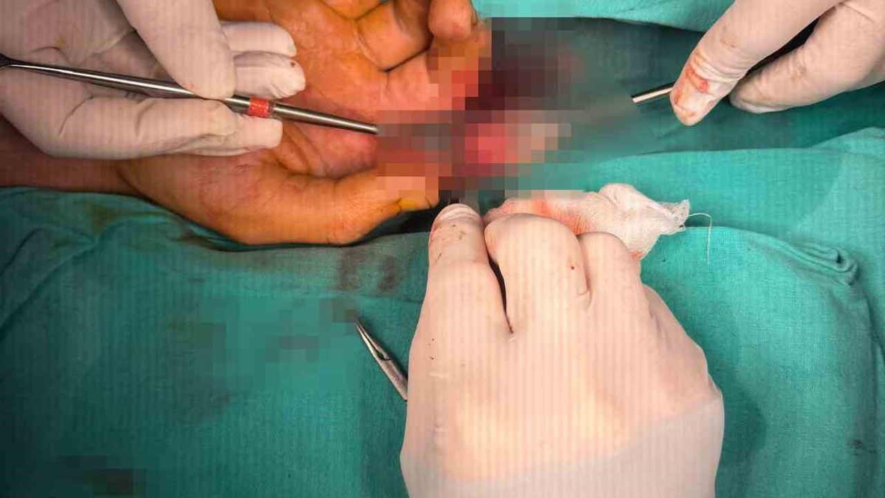 Bandırma'da kopan parmak mikrocerrahiyle yerine dikildi