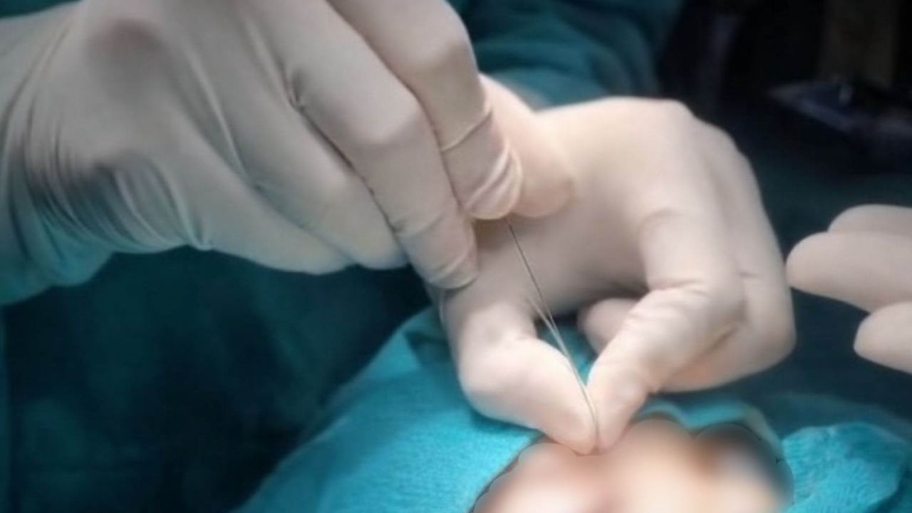 Çukurca Devlet Hastanesi'nde gözyaşı kanalı ameliyatları başladı