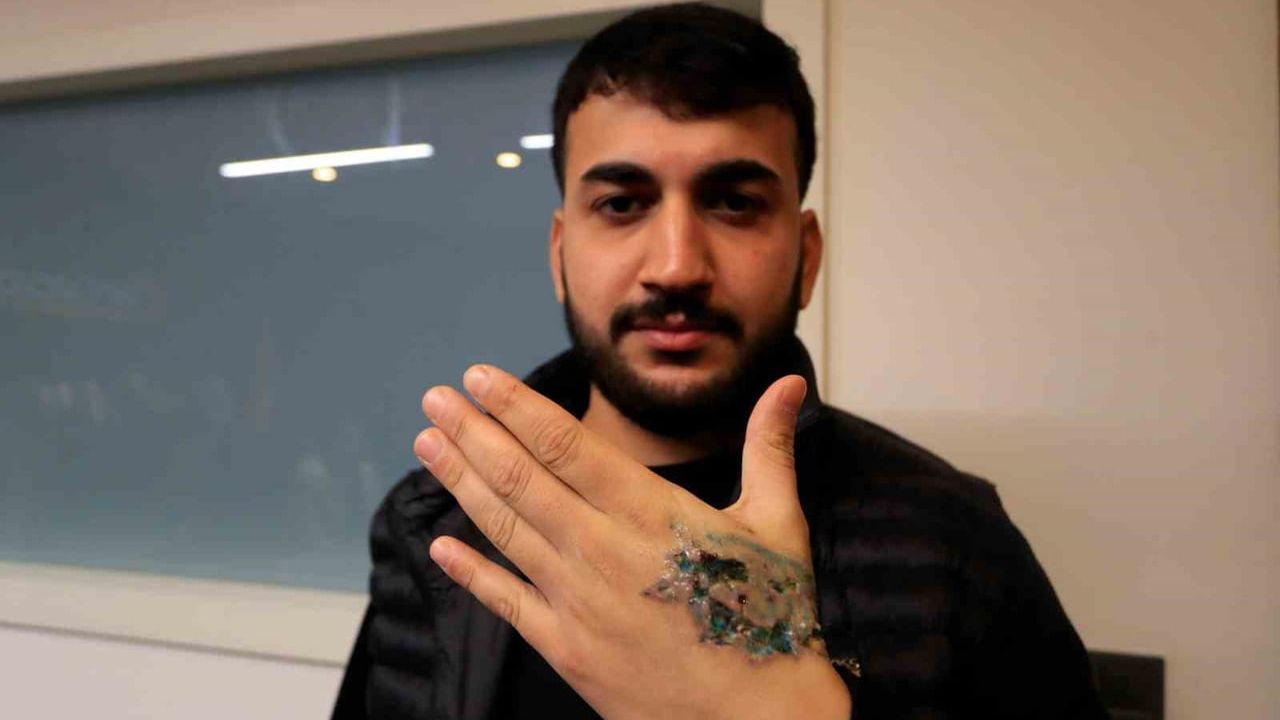 Dövme sildirme işlemi sonrası elinde ikinci derece yanık oluştu