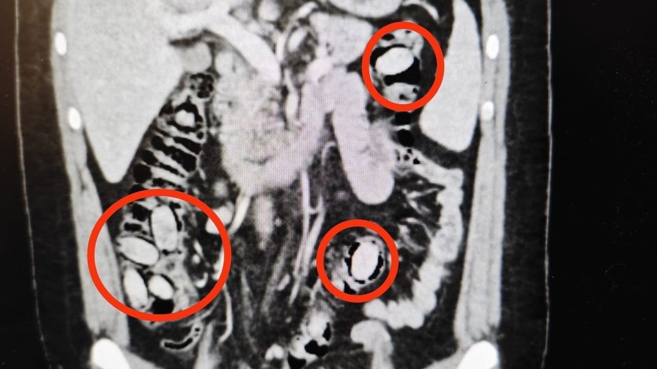 Eskişehir'de midesinde 44 kapsül uyuşturucu taşıyan kişi yakalandı