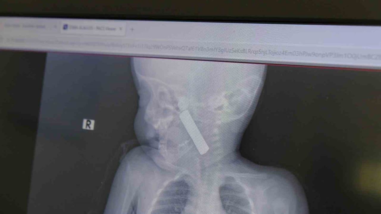 Karaman’da boğazına kumanda pili kaçan 6 aylık bebek ameliyatla kurtarıldı