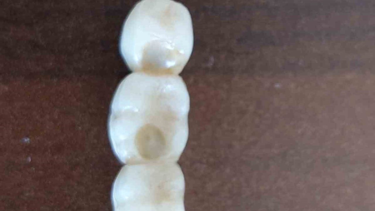 Kayseri’de implant sorunu: Zemzem Korkmazer iki yıldır mağdur