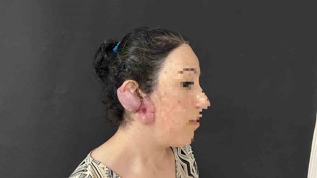 Muş’ta ilk kez uygulandı: Kulak keloidi ödüllü teknikle çıkarıldı