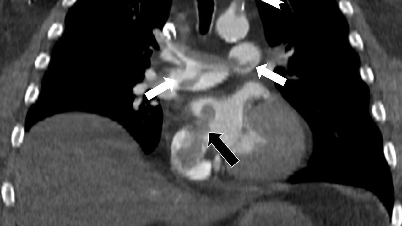 Prof. Dr. Nevzat Karabulut: Kalpteki gizli delikler paradoks emboliye yol açabilir