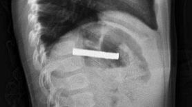 Elazığ'da 3 Yaşındaki Çocuğun Yutduğu Mıknatıslar Başarıyla Çıkarıldı