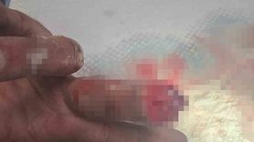 Buzlu poşetle korudu, 600 km getirip kopan parmağını yeniden diktirdi