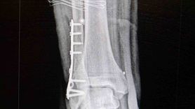 Ortopedi Uzmanı Uyardı: Herkes Her Sporu Yapamaz, Ancak Herkes Bir Spor Yapabilir