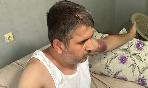 Adana'da Miras Kavgası İçin Dayısından Beyzbol Sopasıyla Darbe Alan Kişi Yaralandı