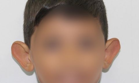 Kepçe kulak çocuklarda özgüveni zedeler: Erken müdahale önemli