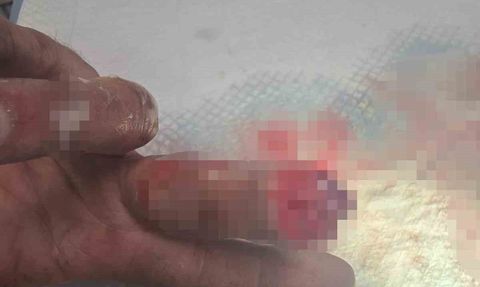 Buzlu poşetle korudu, 600 km getirip kopan parmağını yeniden diktirdi