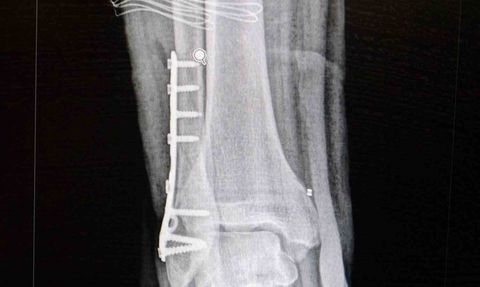 Ortopedi Uzmanı Uyardı: Herkes Her Sporu Yapamaz, Ancak Herkes Bir Spor Yapabilir