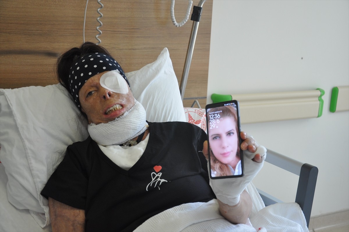 İstanbul'da 4 yıl önce ayrılmak istediği erkek arkadaşının kezzap dökmesi sonucu sol gözünü...