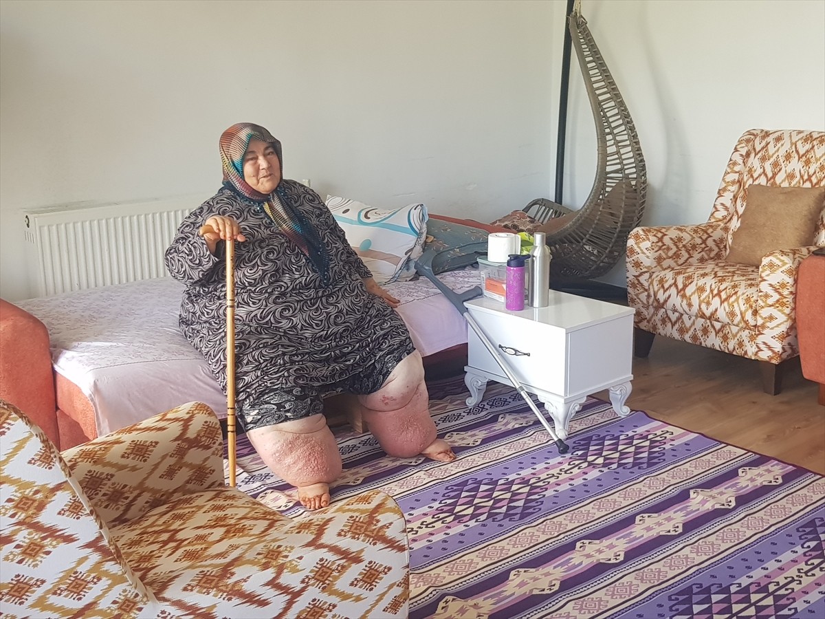  Osmaniye'de yaşayan ve fil hastalığı (Lenfödem) nedeniyle aşırı kilo alan ve dışarı çıkamayan...