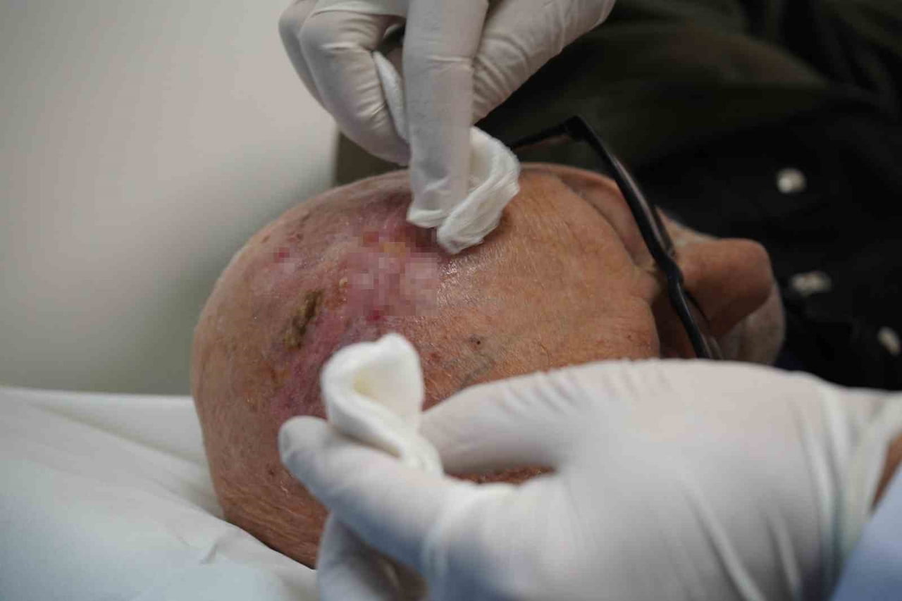 SAÇLI DERİDE GÖRÜLEN VE DÜNYADA SON DERECE NADİR RASTLANAN TÜMÖR TÜRLERİNDEN BİRİ OLAN...