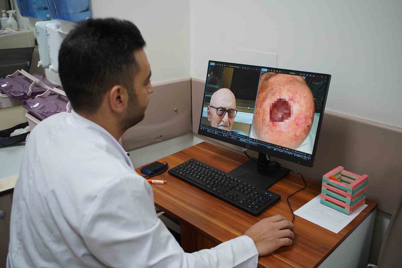 SAÇLI DERİDE GÖRÜLEN VE DÜNYADA SON DERECE NADİR RASTLANAN TÜMÖR TÜRLERİNDEN BİRİ OLAN...