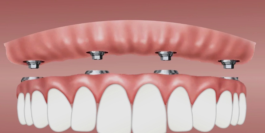 Son Dakika: İmplant Tedavisi Artık Ücretsiz mi Olacak? Milyonlarca Kişiyi İlgilendiren SGK Hamlesi!