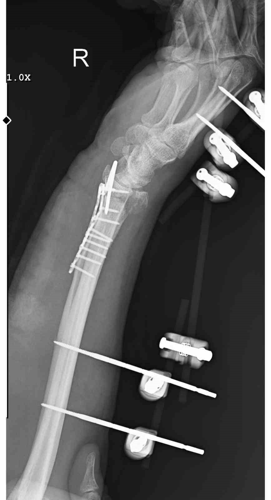 ANKARA’DA SAHİPSİZ KÖPEK SÜRÜSÜNÜN SALDIRISINDAN KAÇMAYA ÇALIŞIRKEN AYAĞININ KAYMASI SONUCU DÜŞEN...