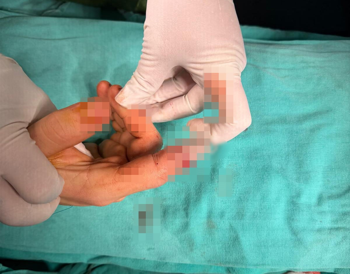 BANDIRMA’DA ASANSÖR KAZASINDA KOPAN PARMAK BAŞARILI AMELİYATLA KURTARILDI