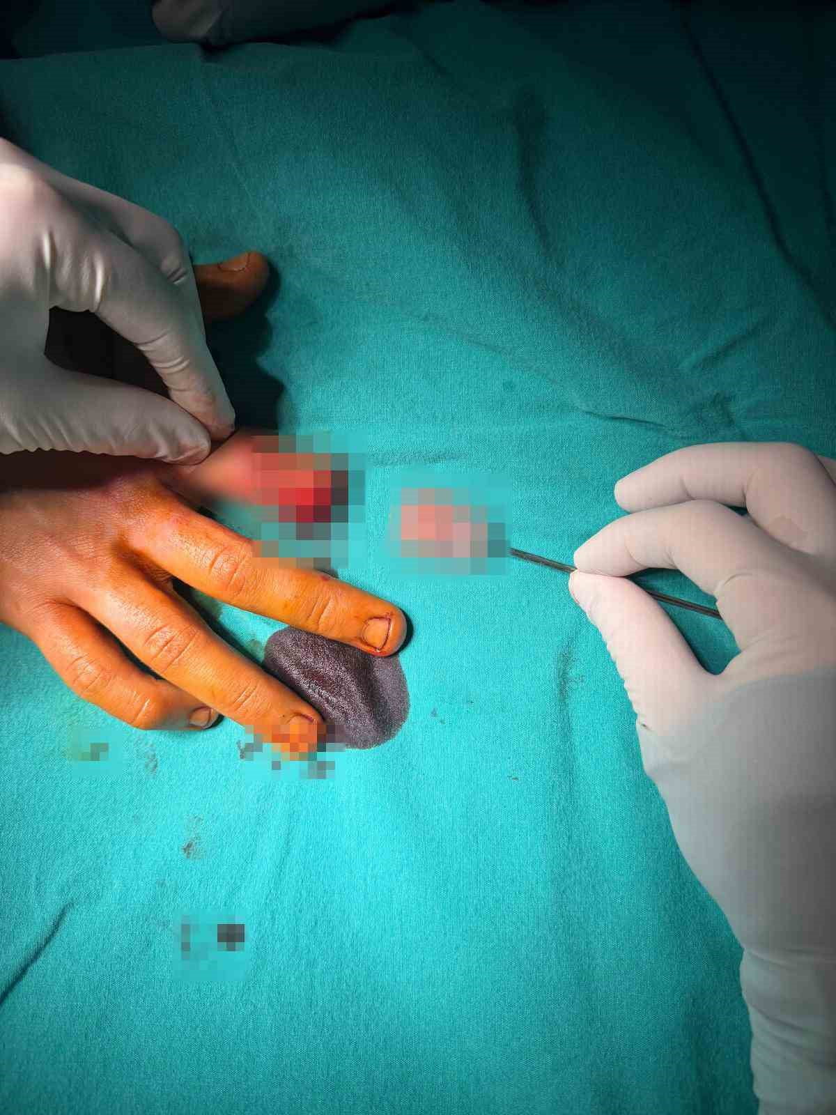 BANDIRMA’DA ASANSÖR KAZASINDA KOPAN PARMAK BAŞARILI AMELİYATLA KURTARILDI