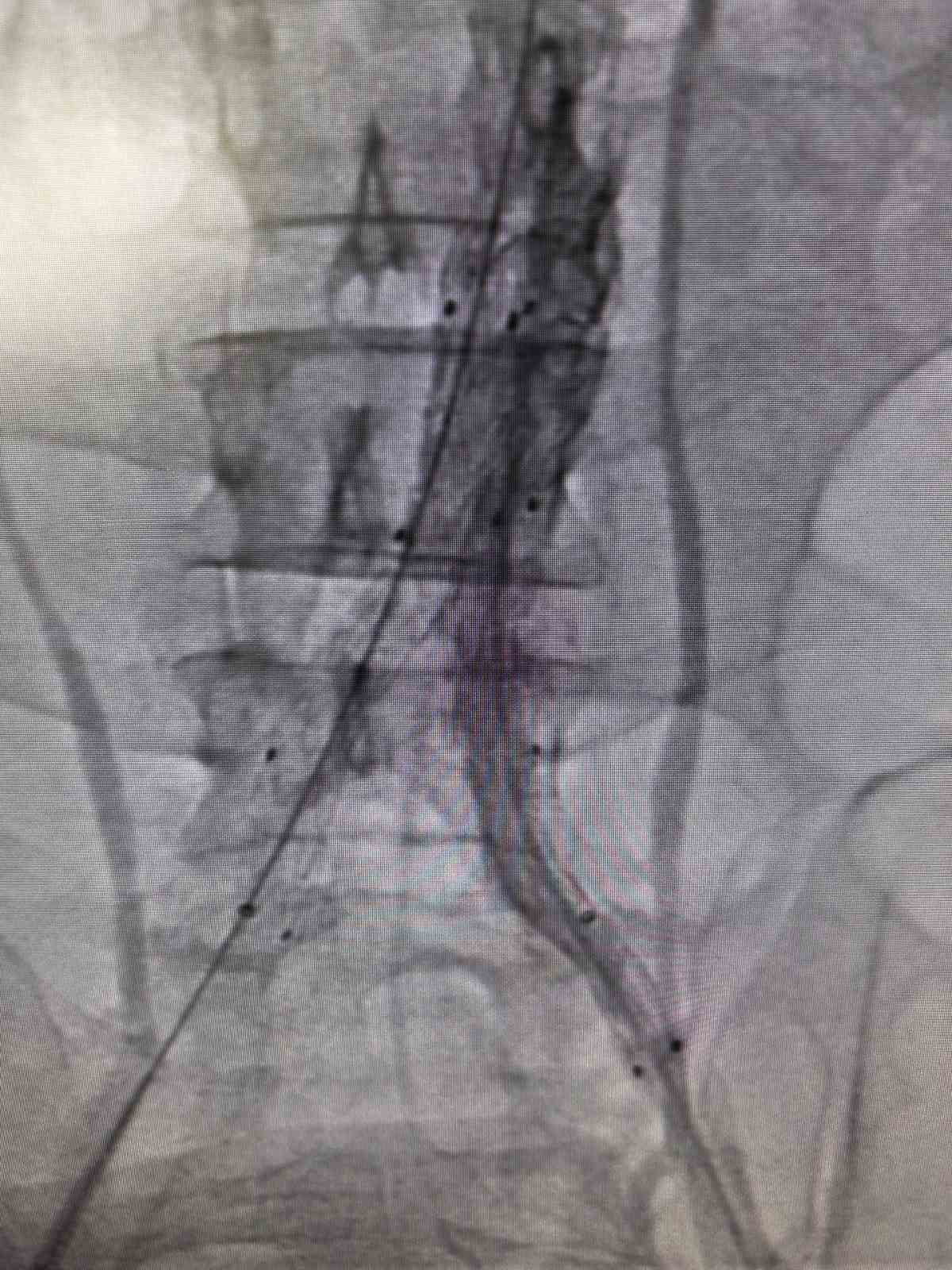 BİLECİK'TE HAYAT KURTARAN KAPALI DAMAR TEDAVİSİ