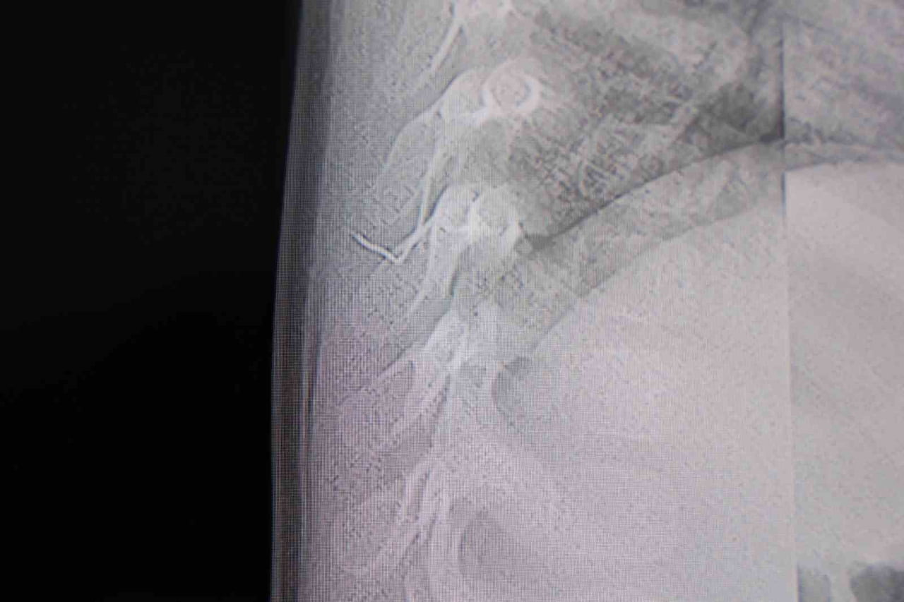 KAHRAMANMARAŞ'TA SIRT ŞİKAYETİ NEDENİYLE HASTANEYE GÖTÜRÜLEN BİR YAŞINDAKİ BEBEKTE 2 SANTİMETRELİK...