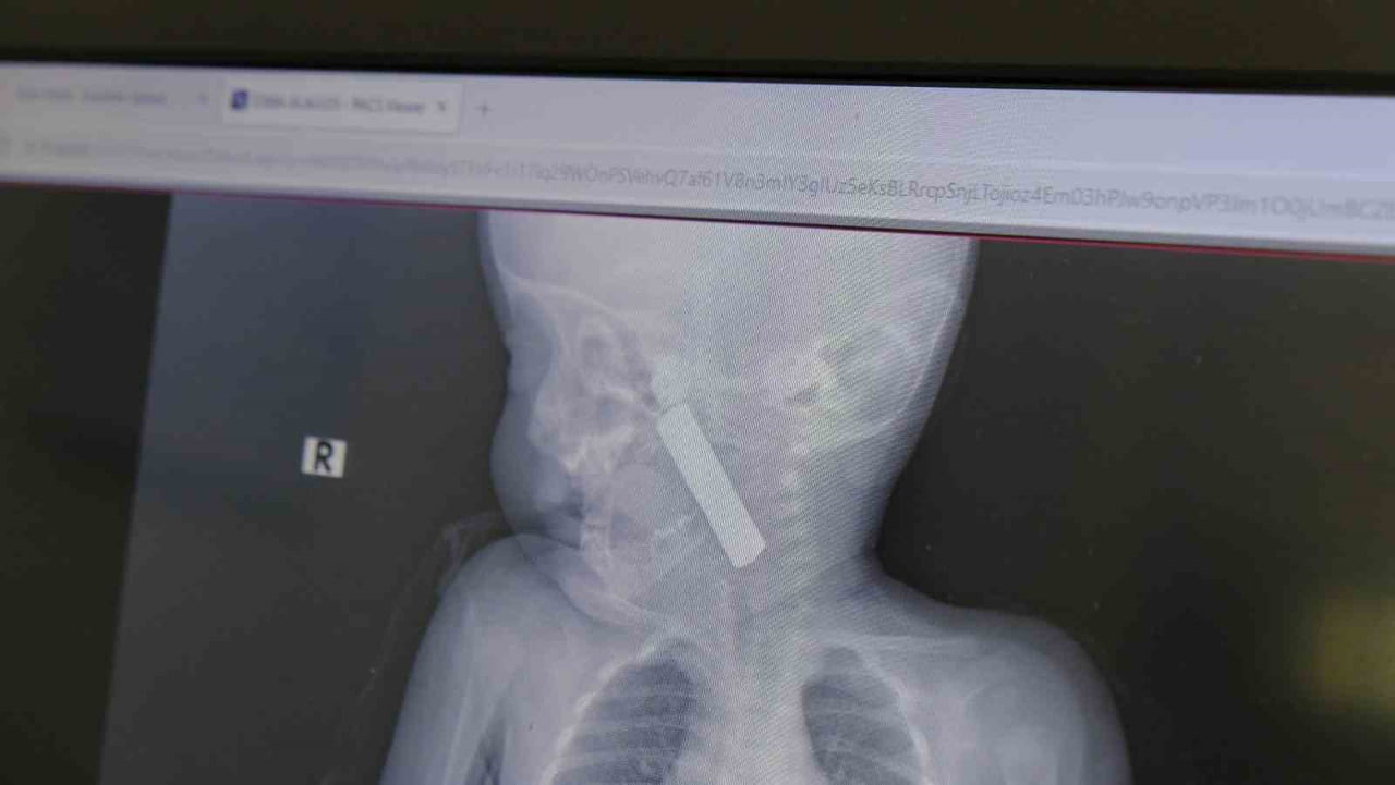 KARAMAN'DA 6 AYLIK BEBEĞİN BOĞAZINA KAÇAN KUMANDA PİLİ, AMELİYATLA ÇIKARILDI.